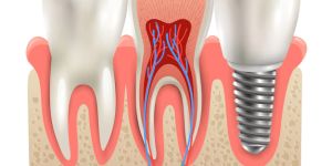 Painless Root Canal Treatment