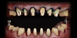 Solid Zirconia Crown