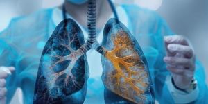 Lung Cancer Treatment Service