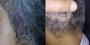 Hair Fall Treatment