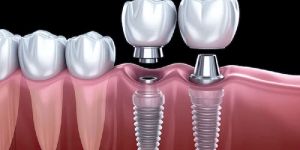 Dental Implants