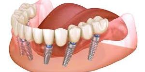 Dental Implants