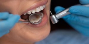 Dental Implants
