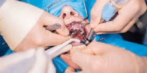 Maxillofacial Implants