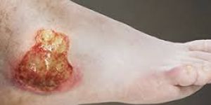 Chronic Non-Healing Wounds online consultation