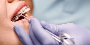 Orthodontic Treatment