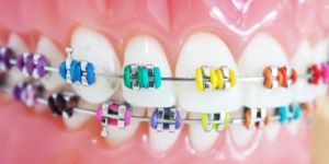 Dental Braces