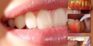 Gum Treatment