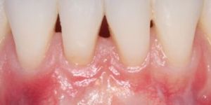 Mucogingival Surgery