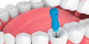 Root Canal Treatment