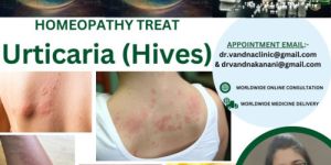 Online Homeopathy Consultation Services Urticaria Skin Problem