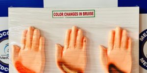 Color Change in Bruise Model