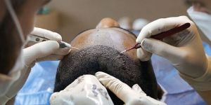 Hair Transplantation