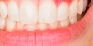 Advanced Gum Treatments