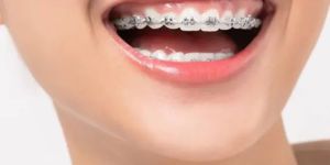 Braces and Aligners