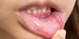 Mouth Ulcers Treatment Services