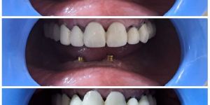 Dental Implant Surgery