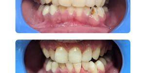 Teeth Grinding Treatment