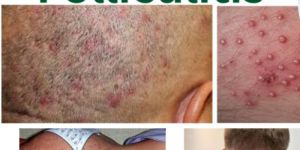 Best Homeopathy Doctor For Skin Problem Folliculitis