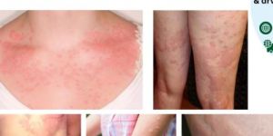 Best Homeopathy Doctor For Skin Problem Chronic Urticaria