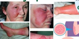 Best Homeopathy Doctor For Skin Problem Erysipelas