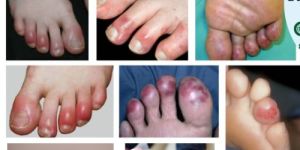 Online Doctor Consultations For Skin Problem Chilblains