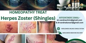 Online Homeopathy Consultation Services For Skin Problem Herpes Zoster