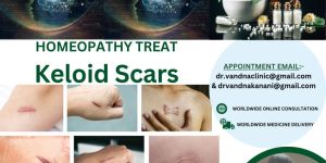 World Best Homeopathic Physicians Consultation For Skin Problem Keloid Scars