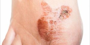 Skin Fungal Infection Treatment Service
