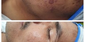 Acne Treatment Services