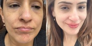 Anti Aging Treatment