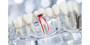 Root Canal Treatment