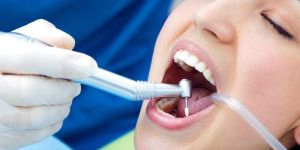 Dental Fillings in Wakad