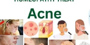 Online Homeopathy Consultation Services Acne Skin Problem
