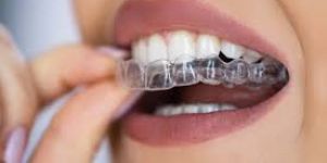 Braces & Aligners