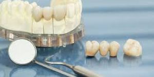 Dental Crown Bridges
