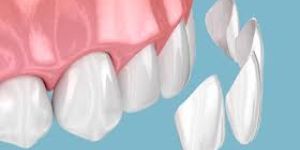 Dental Veneers