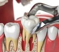 Tooth Extraction