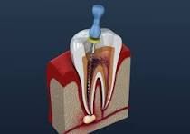 Root Canal Treatment