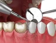 Teeth Cleaning Services