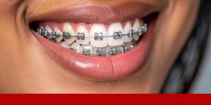 Dental Braces Treatment