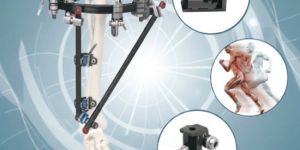 External Fixators