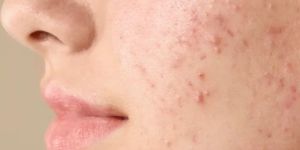 Acne Laser Treatment Services