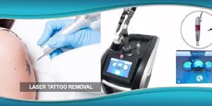 Laser Tattoo Removal Machine