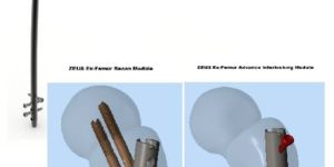 ZEUS Expert Femur Nail All in One