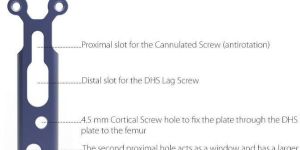 Trochanteric Stabilizing Plate
