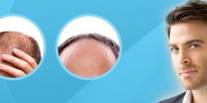 Hair Transplant Services