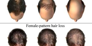 Dandruff Treatment, Psoriasis Treatment