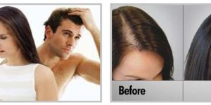 Hair Loss
