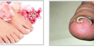 INGROWN TOE NAIL SURGERY